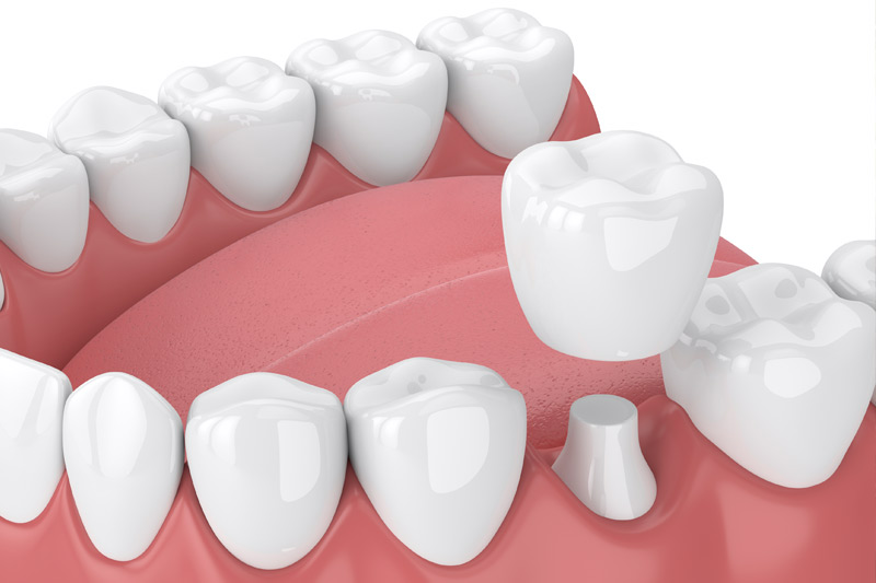 Dental Crowns in McKinney