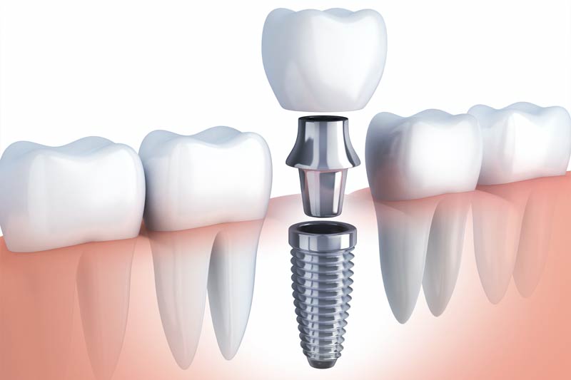 Implants Dentist in McKinney