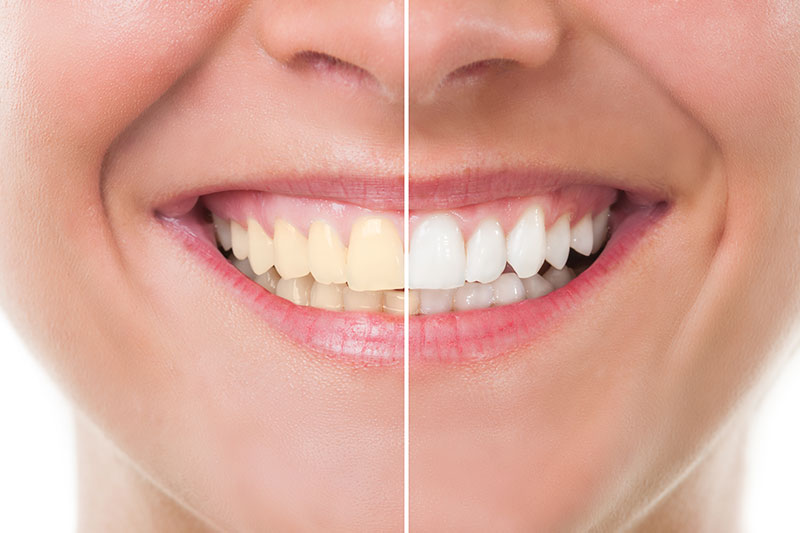 Teeth Whitening in McKinney