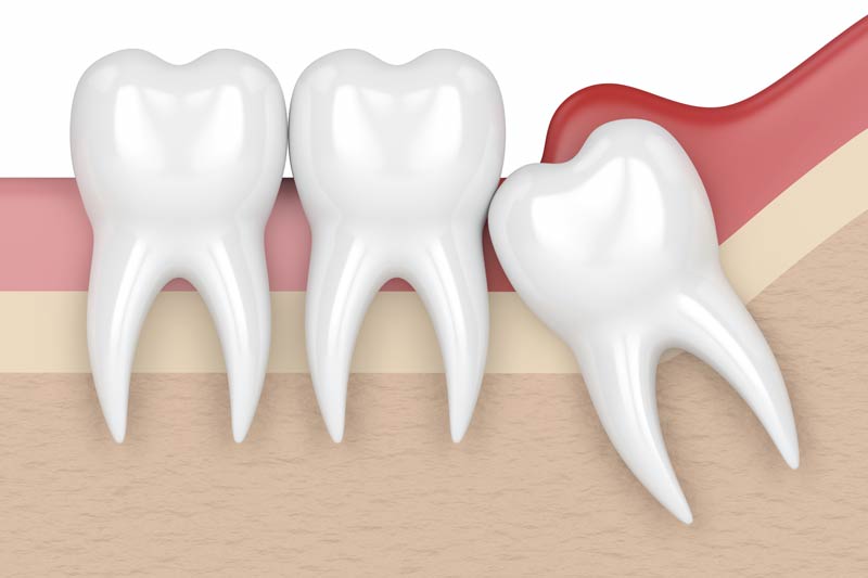 Wisdom Tooth Removal in McKinney